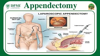 Appendectomy Appendix Removal Surgery Two Types of Appendectomy Complication of Appendectomy [upl. by Arty]