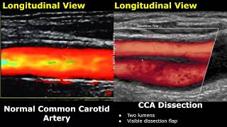 Carotid Artery ColorSpectral Doppler Ultrasound Normal Vs Abnormal Images  ICA Stenosis USG [upl. by Dace]