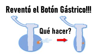 😱SE ROMPIÓ el botón de Gastrostomía😱 Cómo SOLUCIONARLO FÁCIL💚💚 [upl. by Elvin]