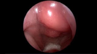 Nasopharyngeal Carcinoma NPC Endoscopic View of Nasopharynx Versus Normal [upl. by Heilman]