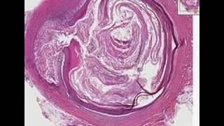 Histopathology SkinEpidermal inclusion cyst [upl. by Elleina965]