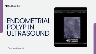 Endometrial Polyp in Ultrasound [upl. by Ahsenrac]