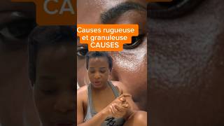 Peau rugueuse peau granuleuse causes et solutions rapides partie 1 [upl. by Hafital]