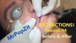 Severe Acne extractions Session 4 amazing before and after So many pops [upl. by Llemij905]