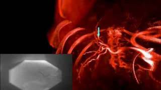 Medical Imaging Registration of Angiographic Images [upl. by Ariahaj33]