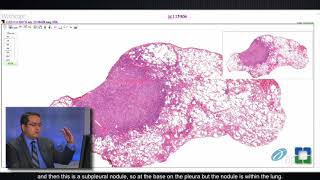 Lung Granulomas Caused by Fungal Infection [upl. by Ha]