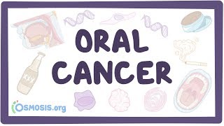 Oral Cancer  causes symptoms diagnosis treatment pathology [upl. by Ambros]