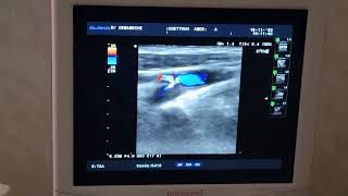 sténose serrée de la carotide interne proximale indication dune endarteriectomie [upl. by Mahsih]