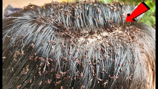 Long Hair Lice Treatment Removal  Head Lice Treatment Step by Step [upl. by Fredkin168]