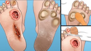 Foot Treatment  Remove Insect Warms  Cleaning Infection Feet  Foot Treating asmr [upl. by Nnylecoj]