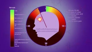 Cluster headache attack [upl. by Leeth]