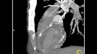 Vascular Diseased LAD 3D and 4D mapping of the coronary CT angiogram2 of 2 [upl. by Edgerton925]