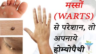 How to Remove WartsGenital Warts  BEST HOMEOPATHIC MEDICINES IN 2020 मस्से [upl. by Enerahs44]