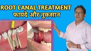 RCT के फ़ायदे और नुक्सानBenefits of Root Canal Treatmentrct rcttreatment [upl. by Ernie761]