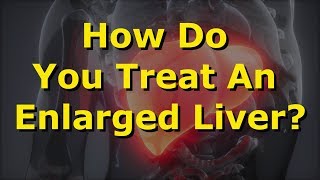 How Do You Treat An Enlarged Liver [upl. by Icram]