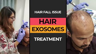 Exosomes Treatment for Hair Fall Issue  HASH CLINICS [upl. by Nerty146]