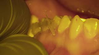 autotransplant of a wisdom tooth [upl. by Hudson336]