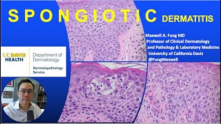 DERMATOPATHOLOGY Spongiotic Dermatitis [upl. by Resaec]