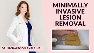 Can We Remove A Benign Breast Lump Without Surgery Yes Dr Richardson Explains [upl. by Menell]