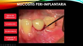 Mucositis y periimplantis [upl. by Hole508]