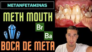 METH MOUTH  BOCA DE METANFETAMINA o CRISTAL  Efectos secundarios del abuso de drogas [upl. by Ainet]