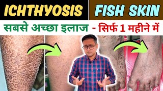 Fish skin  Ichthyosis vulgaris  Xlinked ichthyosis  Treatment  Hindi [upl. by Conners226]