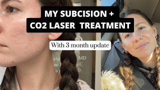 Getting a subcision  ablative CO2 Laser treatment  3 month update [upl. by Oenire]