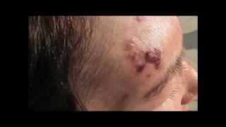 Shingles Herpes Zoster on a patients forehead before and during treatment [upl. by Franciskus765]