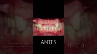 Implantes dentales  Antes y después [upl. by Honora108]