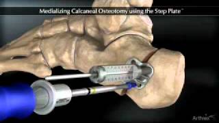 Medializing Calcaneal Osteotomy [upl. by Broida]