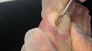 Satisfying Pedicure Asmr  Impacted Toenail Cleaning ASMR pedicure toenail [upl. by Nurav771]