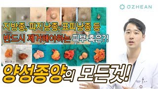 양성종양혹 종기 지방종 피지낭종 표피낭 모낭종 제거에 대하여 단 한번에 정리해드립니다 성형 알려주는 남자 이용석 [upl. by Adnil]