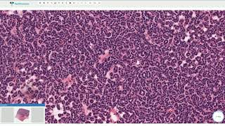 Metanephric Adenoma  Histopathology [upl. by Jamilla]