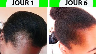 Comment Faire repousser les cheveux des tempes rapidement sans effort Faire pousser cheveux du fron [upl. by Ricker661]