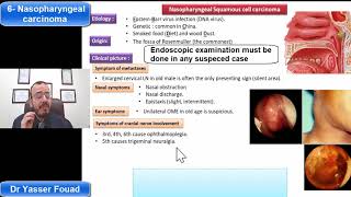 6 Nasopharyngeal Carcinoma [upl. by Eatnuahs]