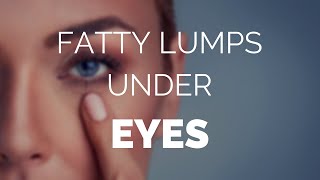 Fatty lumps under eyes and how to treat themFast [upl. by Urbanna]