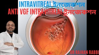 Intravitreal ইনজেকশন  Avastin injection  An intravitreal injection  AntiVEGF treatment [upl. by Jasen]