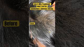 Lice nits removal treatment  lice treatment  lice removal  lice how to remove the nits from hair [upl. by Batty]