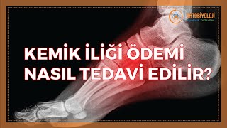 KEMİK İLİĞİ ÖDEMİ NASIL TEDAVİ EDİLİR [upl. by Ayouqat721]