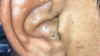 Blackheads Removal behind the Ear [upl. by Gaile178]