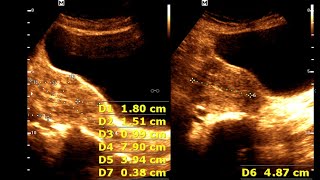 Multiple Fibroid Uterus  Leiomyoma of Uterus  Uterine Benign Tumor [upl. by Ecinnaj]