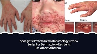 Dermatopathology Lesson 1 Spongiotic Dermatitis Tissue Reaction Patterns [upl. by Patton]