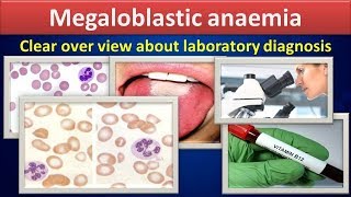 Megaloblastic anemiaClear over view about laboratory diagnosis [upl. by Milissa]