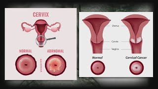 New guidelines on screening for cervical cancer [upl. by Yelsgnik]