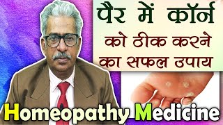 कॉर्न को कैसे ठीक करे  Corns Treatment  Dr PS Tiwari [upl. by Willard]