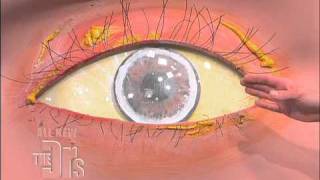 Cholesterol Deposits in the Eye The Doctors [upl. by Ahsimot]