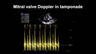 Echocardiography Essentials Detecting pericardial effusions [upl. by Einahteb659]