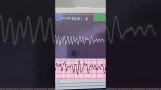 FIBRILACIÓN VENTRICULAR [upl. by Sierra]