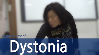 Dystonia  Cervical Dystonia  Spasmodic Torticollis  사경증 치료  근긴장이상증 [upl. by Laura]