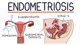 Understanding Endometriosis [upl. by Attenrev]